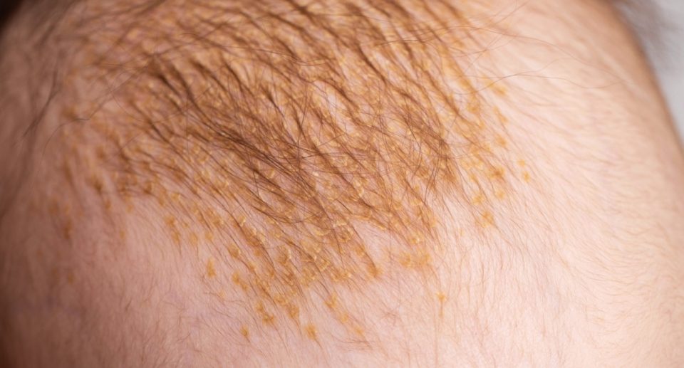 Milchschorf oder Kopfgneis? Unterschiede erkennen und richtig behandeln